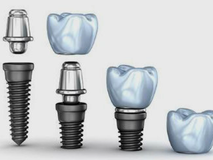 3. Implantes