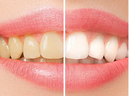 8. Blanqueamiento Láser Blanqueamiento Láser Dental