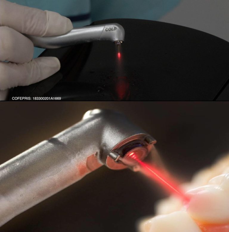 1. Obturaciones Láser Láser Dental